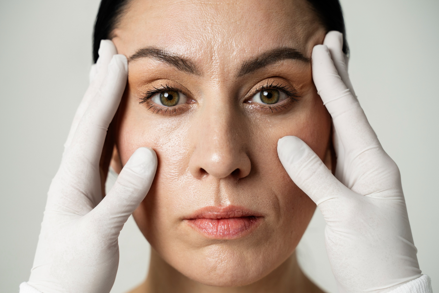 BLEFAROPLASTIA BLEFAROPLASTIA