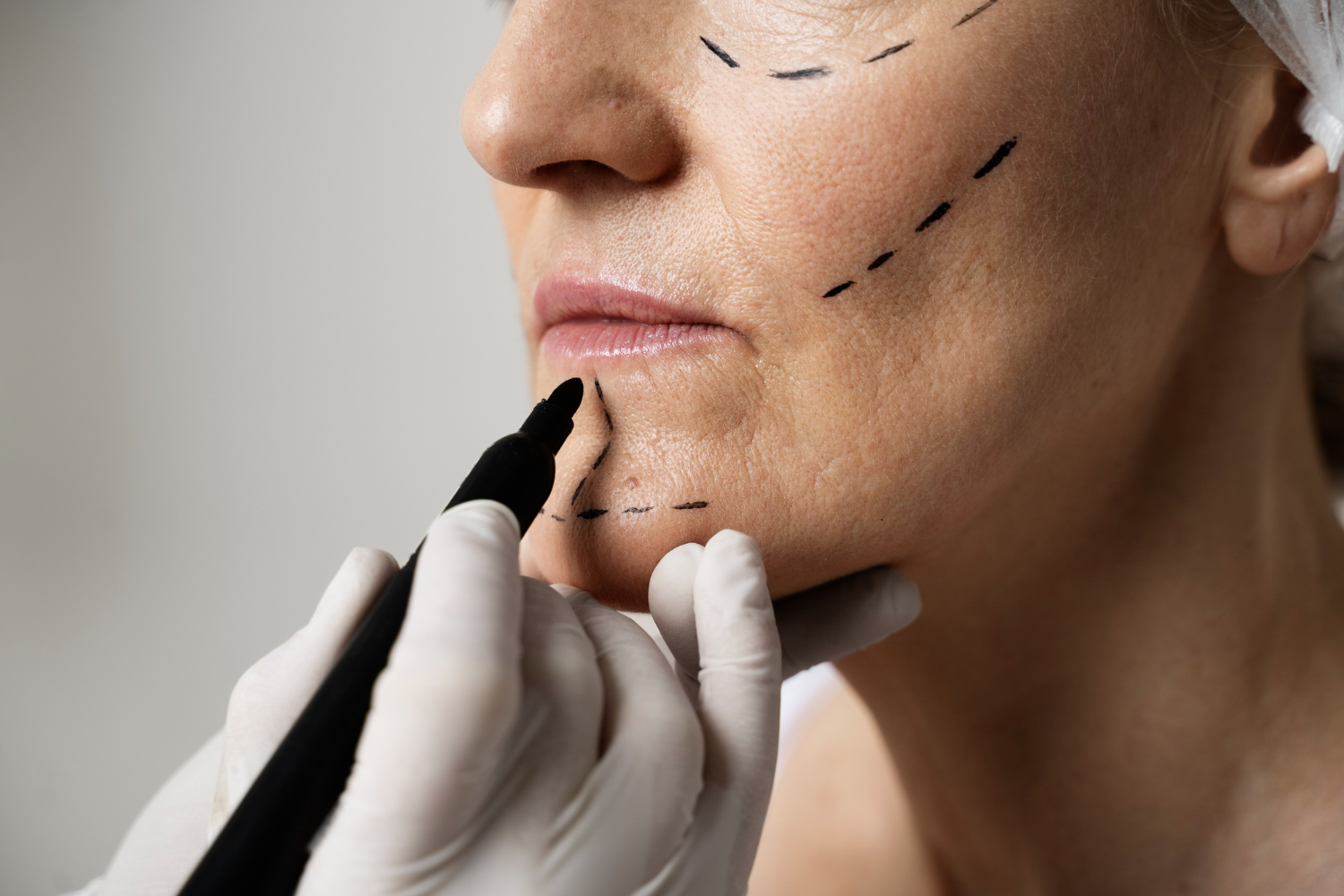 LIPOFILLING / LIPOESCULTURA FACIAL