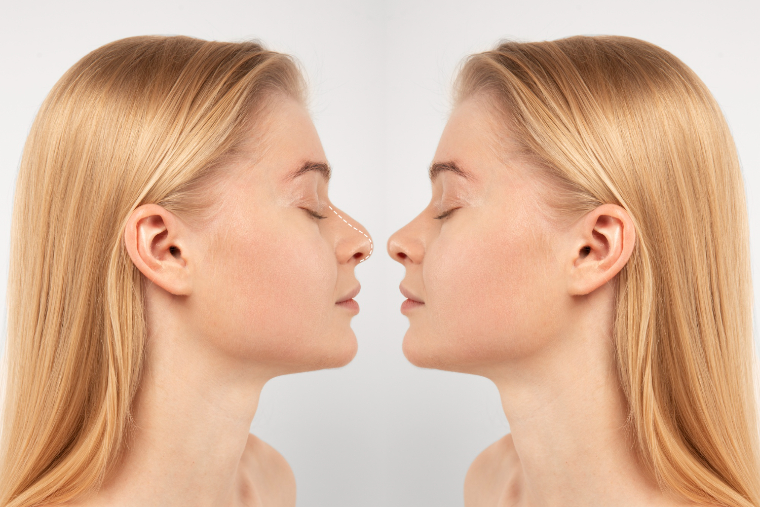 RINOPLASTIA ULTRASÓNICA (PIEZOTOME)