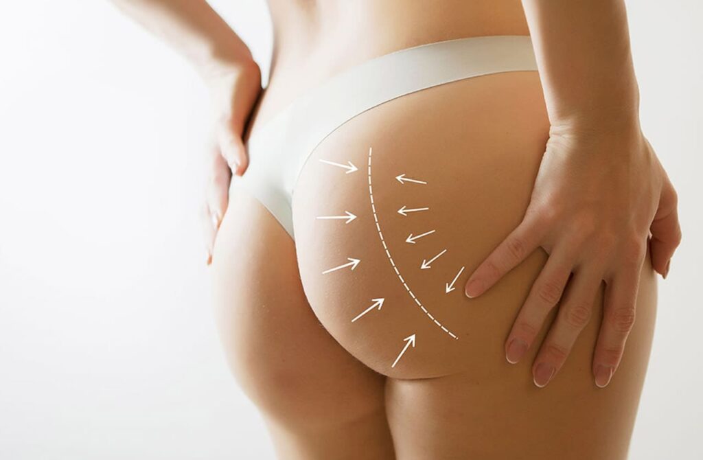 Brazilian Buttlifting Brazilian Buttlifting