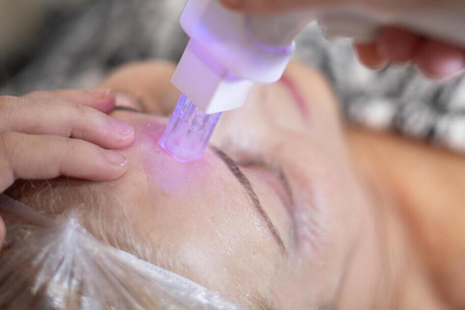 RADIOFRECUENCIA MICROAGUJADA