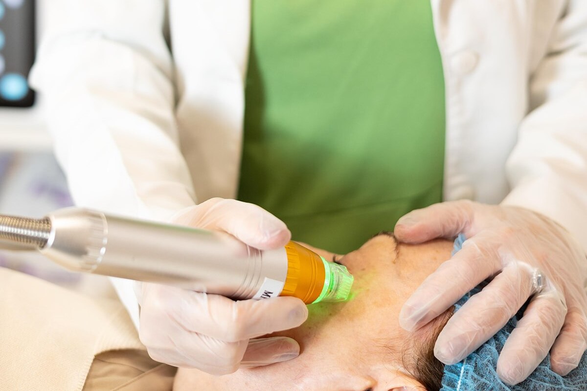 MICROAGUJAS (MICRONEEDLING)