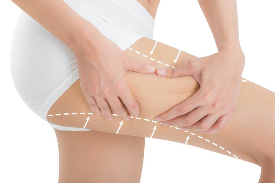 LIFTING CRURAL LIFTING CRURAL