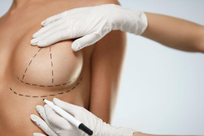 MASTOPEXIA MASTOPEXIA